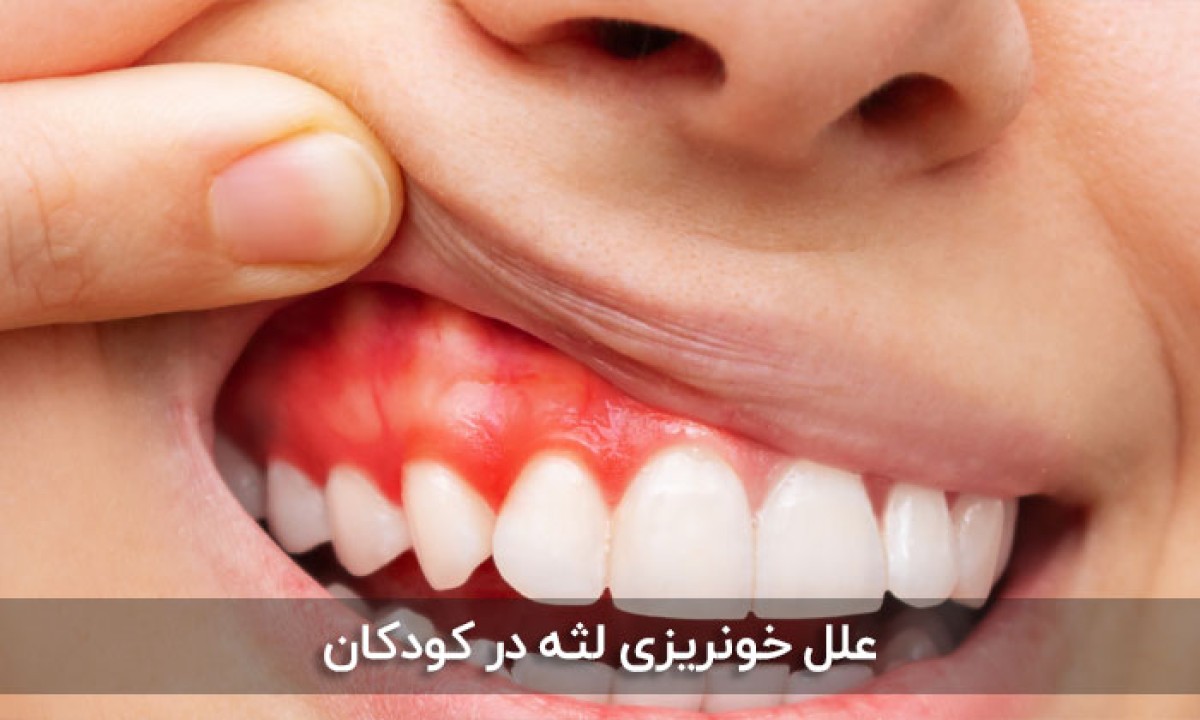 خونریزی لثه را چه زمانی باید جدی گرفت؟ | علت‌ها، نشانه‌های خطر و درمان